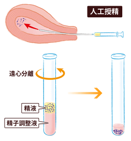 人工授精イメージ