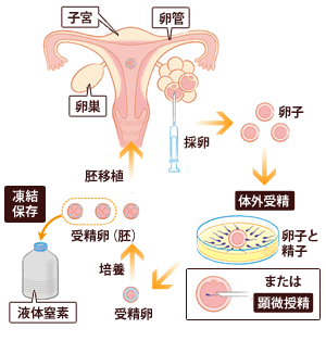生殖補助医療イメージ