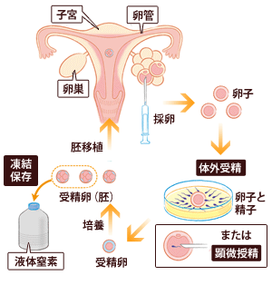 5.生殖補助医療イメージ